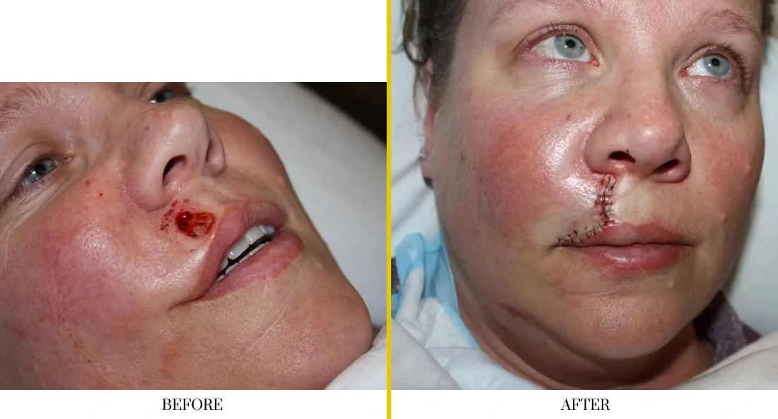 Before and after facial wound reconstruction showing chin laceration healing and sutured closure