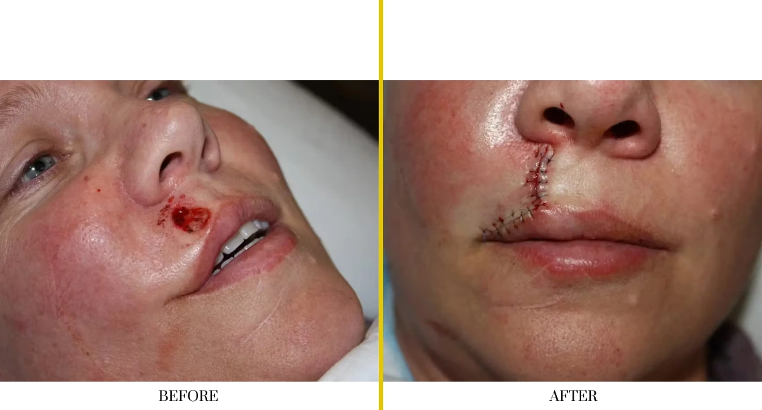 Before and after facial reconstruction: left shows open wound on cheek, right shows healed surgical site with sutures