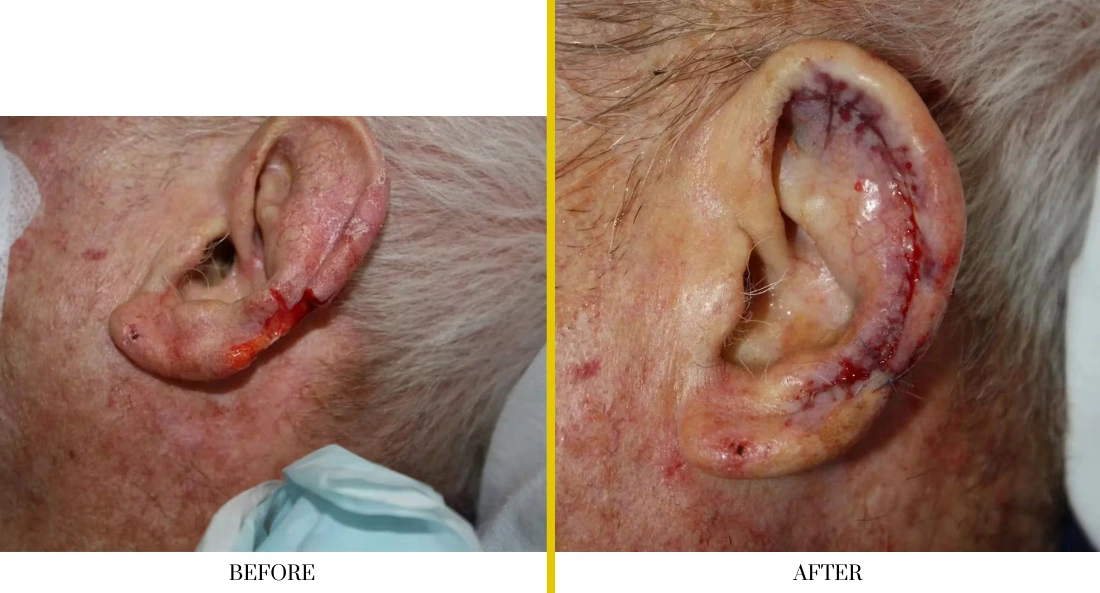Before and after ear laceration repair showing surgical closure and healing