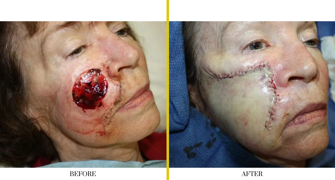 Before and after large facial defect reconstruction showing surgical repair and wound closure