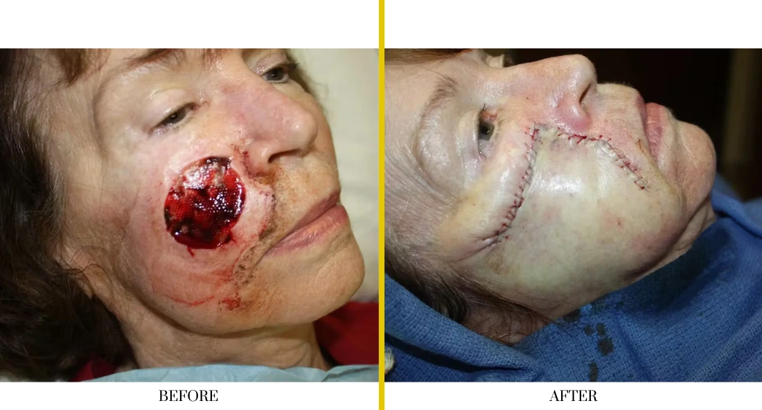 Before and after extensive facial wound reconstruction of cheek and jaw area with surgical closure