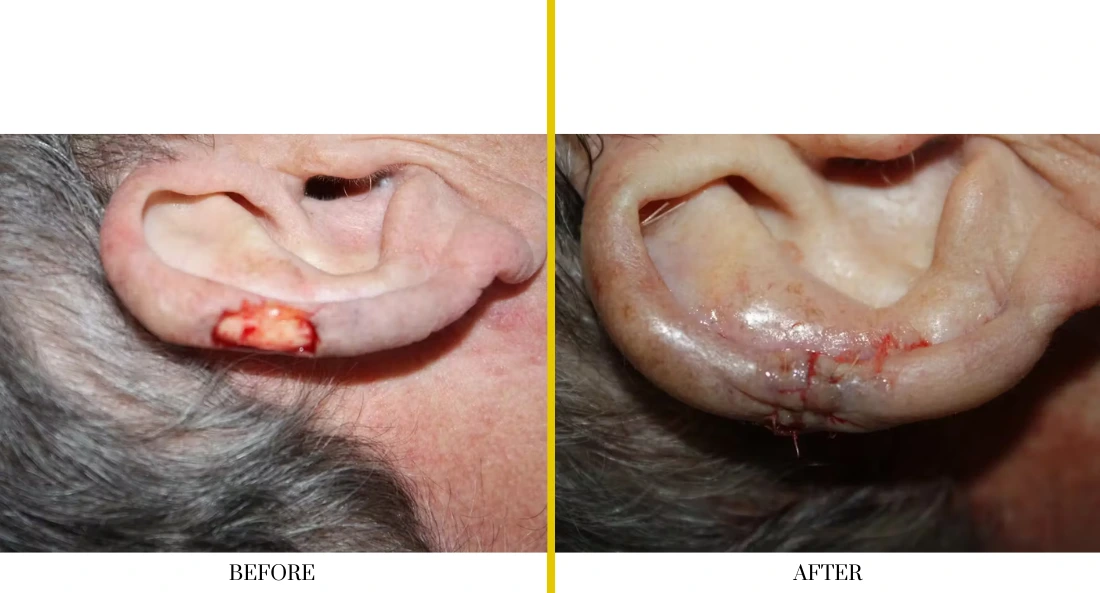 Skull Reconstruction and Cranioplasty (47)