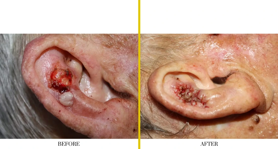 Before and after skull reconstruction: open lesion on ear before, closed scar after cranioplasty healing