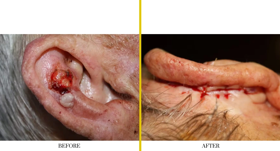 Before and after cranioplasty: open wound on ear and finger before, healed scars after reconstruction surgery