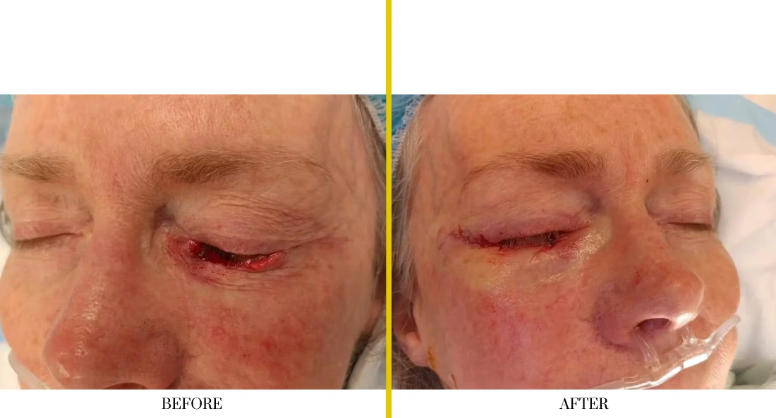 Before and after eyelid reconstruction showing orbital defect and severe swelling before treatment, restored eyelid contour and improved closure after cranioplasty
