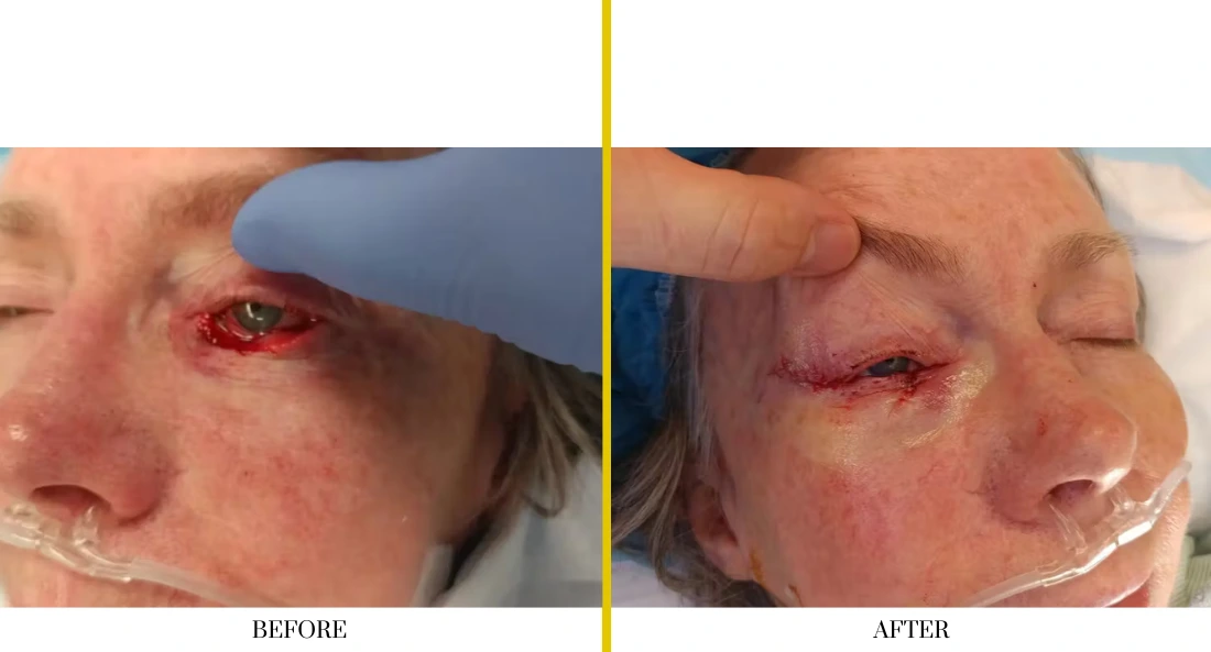 Before and after orbital injury reconstruction showing severe eye trauma and swelling before surgery, improved eyelid closure and healing after cranioplasty