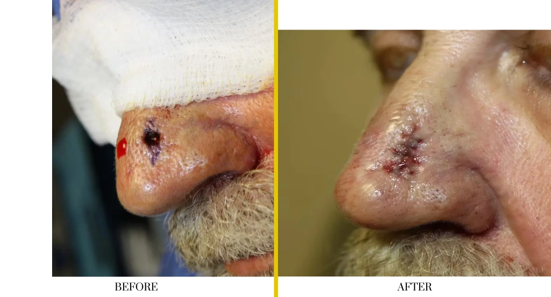 Before and after nasal reconstruction showing significant nasal defect with bandaging before surgery, restored nasal structure and healing after cranioplasty