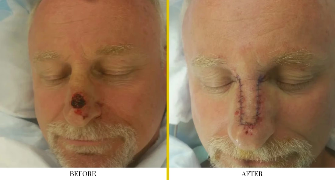 Before and after skull reconstruction: patient with nasal defect and surgical incision marks, then healed with reconstructed nose