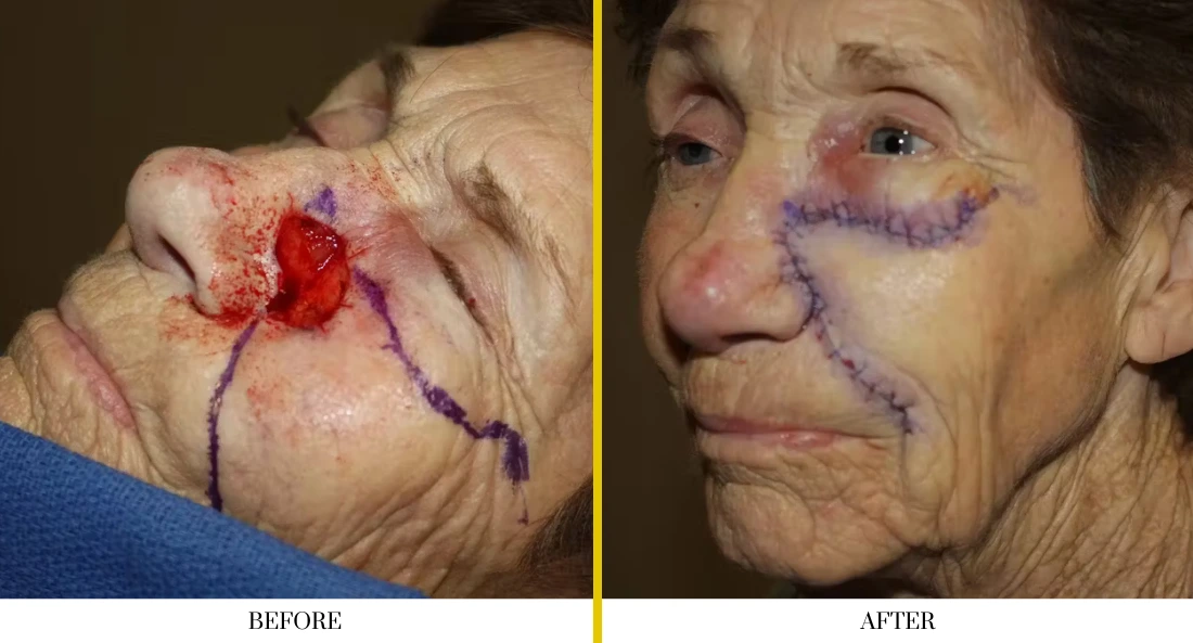 Before and after facial reconstruction: patient with large facial defect marked with surgical lines, then with reconstructed cheek in profile view