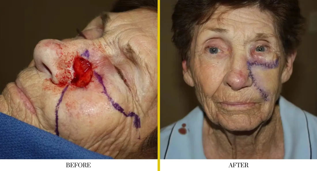 Before and after facial reconstruction: patient with large facial defect marked with surgical lines, then with reconstructed cheek and orbital area