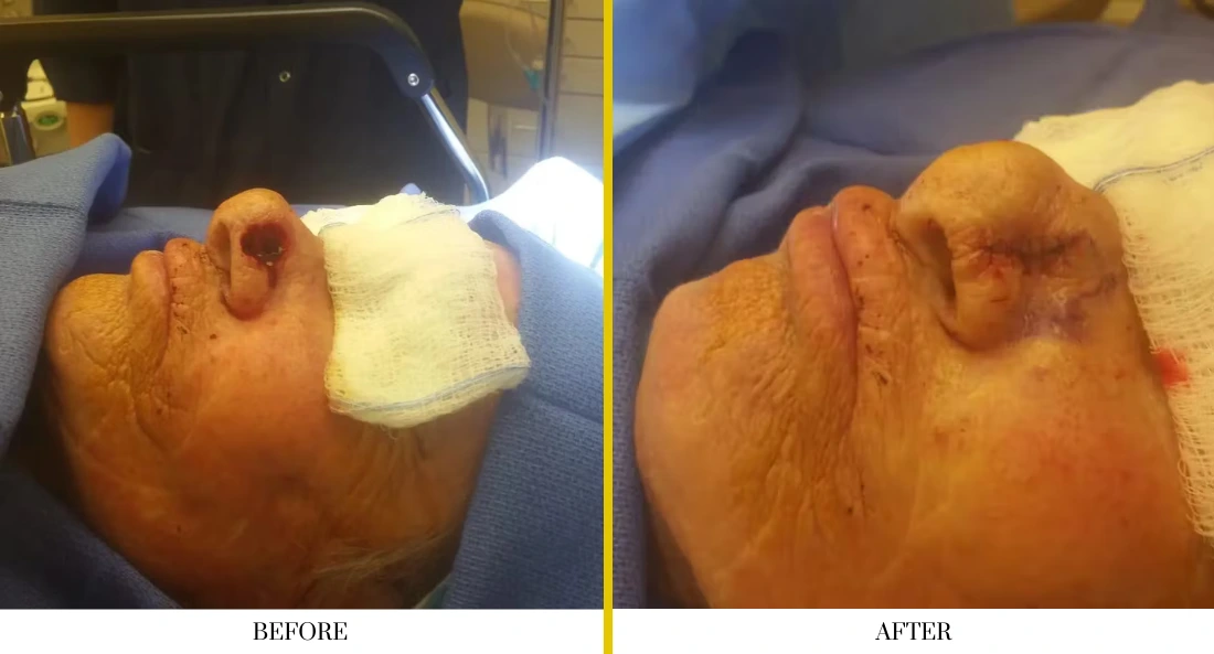 Before and after hand surgery: patient with nasal defect on hand before reconstruction, then restored tissue appearance after surgery
