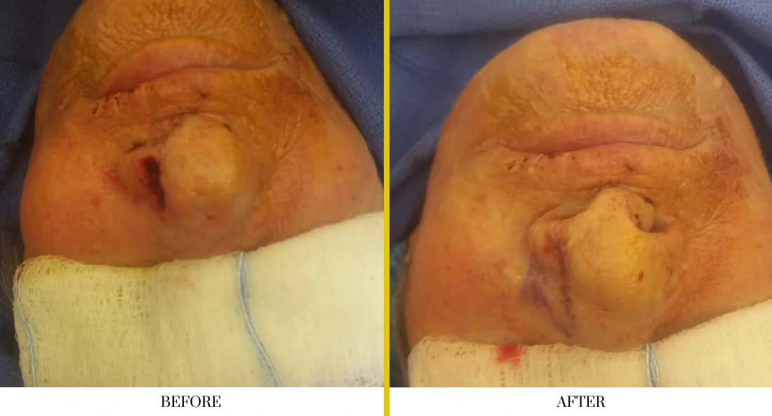 Before and after scalp reconstruction: patient with skull protrusion before surgery, then smooth scalp contour after cranioplasty