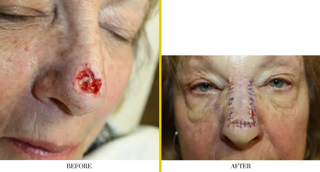 Before and after skull reconstruction: left shows patient with open lesion on cheek; right shows healed surgical site with suture marks on bridge of nose