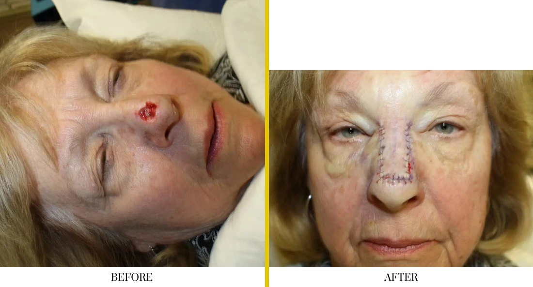 Before and after nasal reconstruction: patient with nasal defect and surgical markings, then healed with reconstructed nasal structure