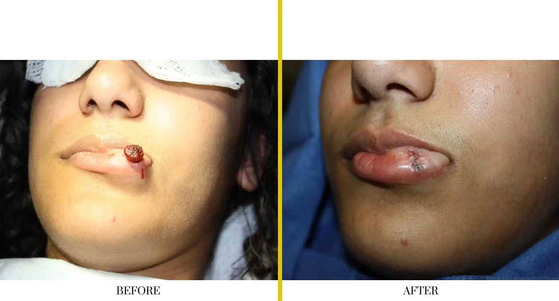 Before and after lip lesion removal: lesion on lower lip, then healed with scar revision