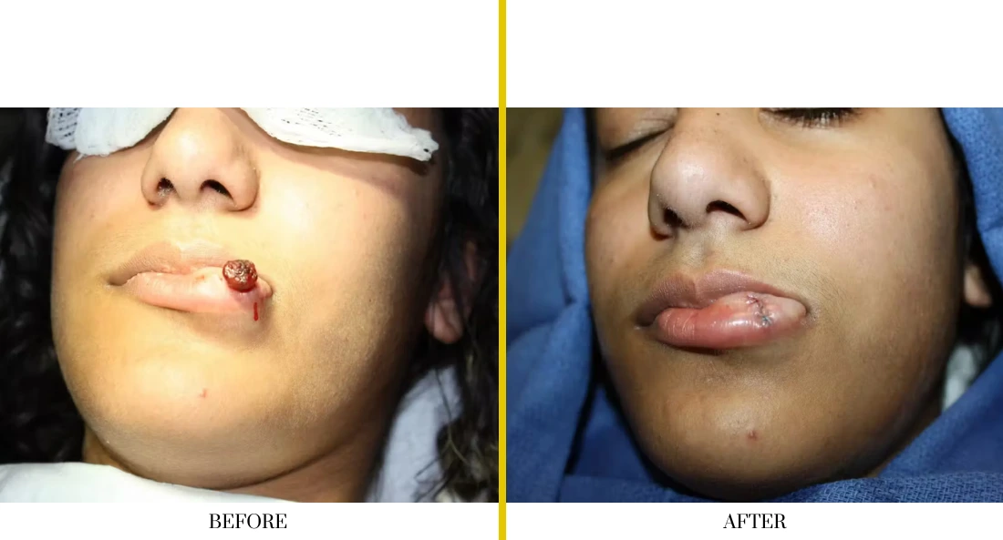 Before and after lip reconstruction: lesion on lower lip, then healed with restored lip appearance