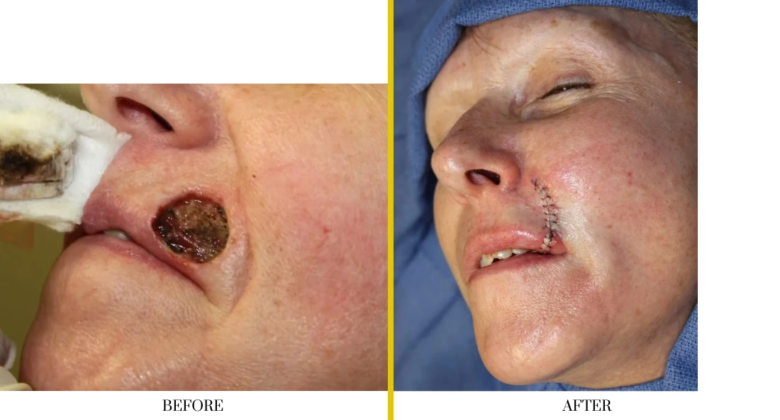 Before and after nasal reconstruction: circular defect near nostril, then healed with surgical closure and scar revision