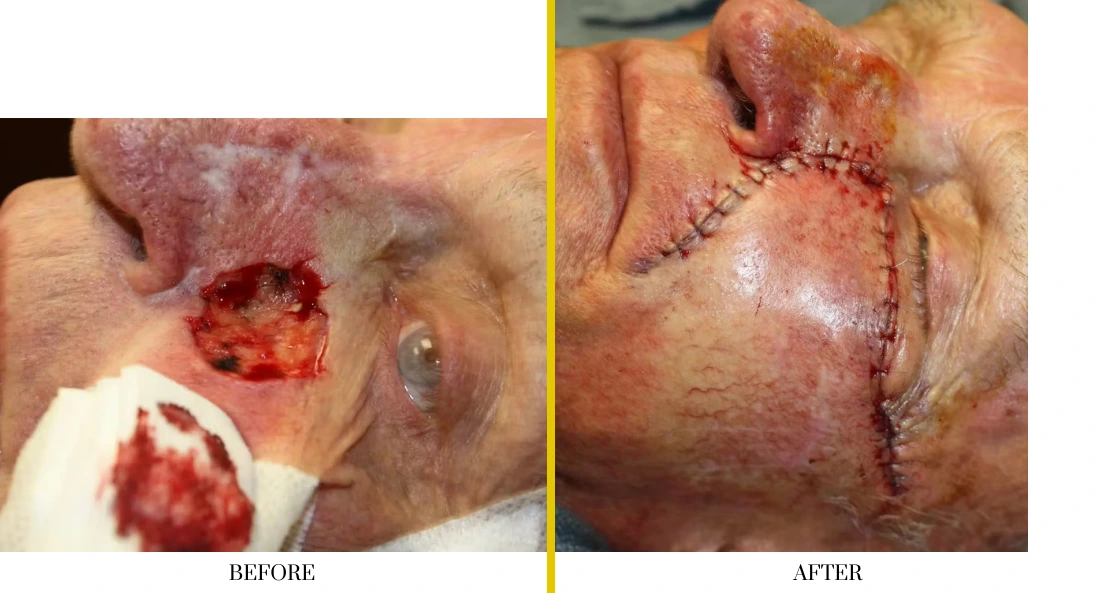 Before and after skull reconstruction: large facial wound before surgery, reconstructed area with surgical sutures after cranioplasty