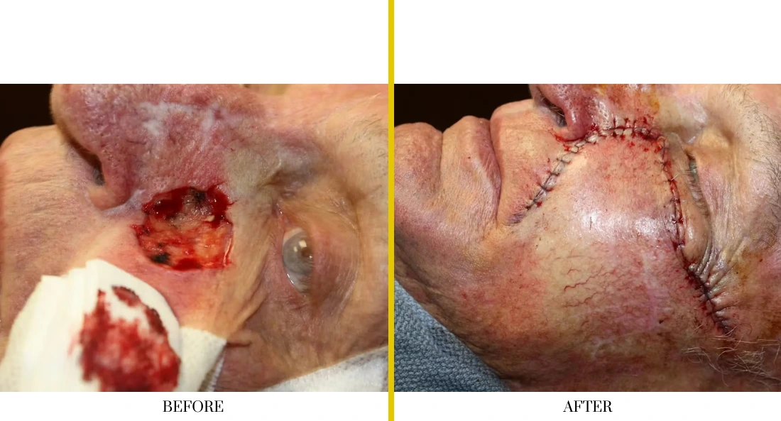 Before and after skull reconstruction: deep facial defect with exposed tissue before surgery, healed surgical site with sutures after cranioplasty
