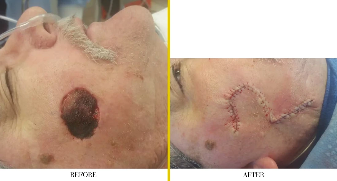Before and after skull reconstruction: dark lesion on forehead before surgery, healed surgical site with suture lines after cranioplasty