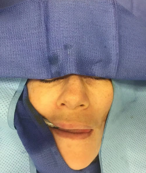 Patient's face covered with surgical drape showing marked surgical area on chin and lower face