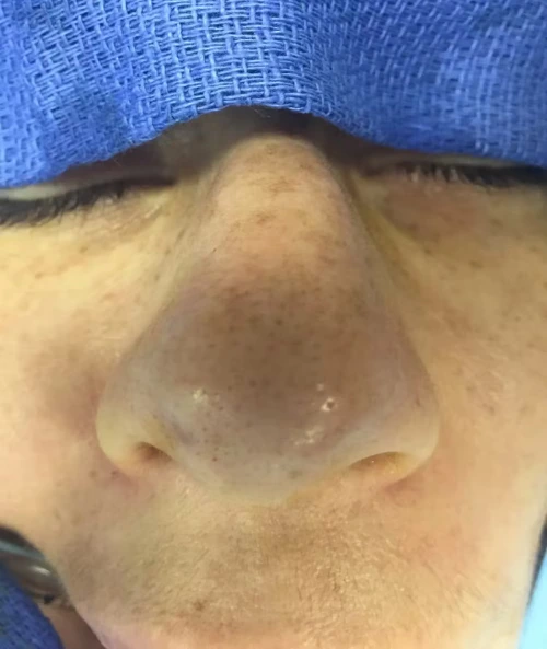 Close-up frontal view of patient's nose showing nasal structure and bridge