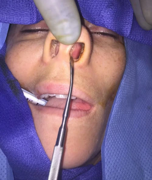 Practitioner using an intraoral device to examine patient's mouth and palate during oral assessment