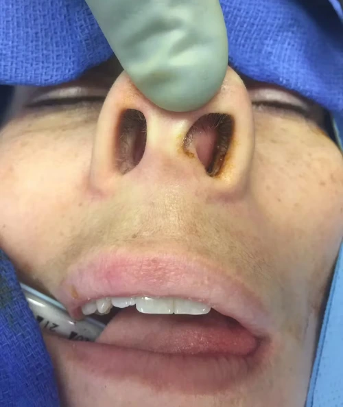 Surgical model showing nasal reconstruction with green prosthetic template applied to patient's nose