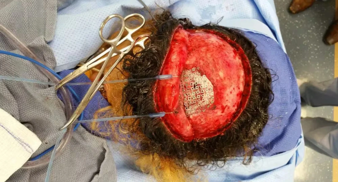Surgical view of skull defect during cranioplasty procedure with exposed bone and surgical instruments