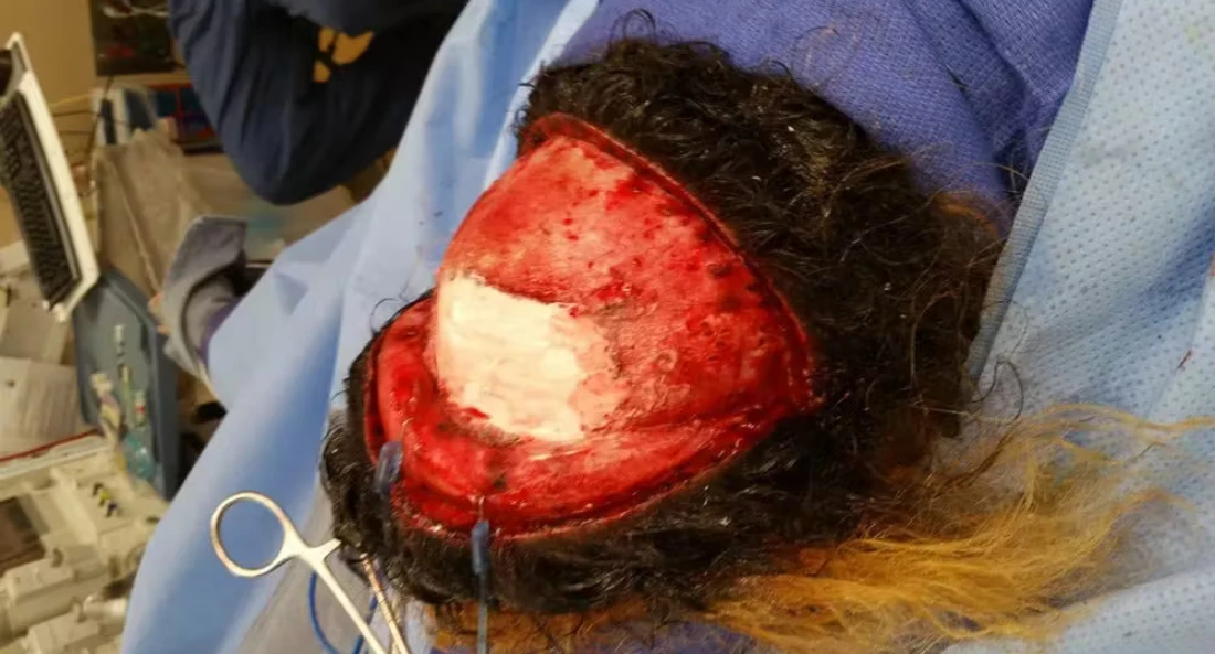 Intraoperative skull reconstruction showing surgical site with bone graft preparation