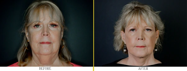 Regency Before & After (602 x 230 px) (2)