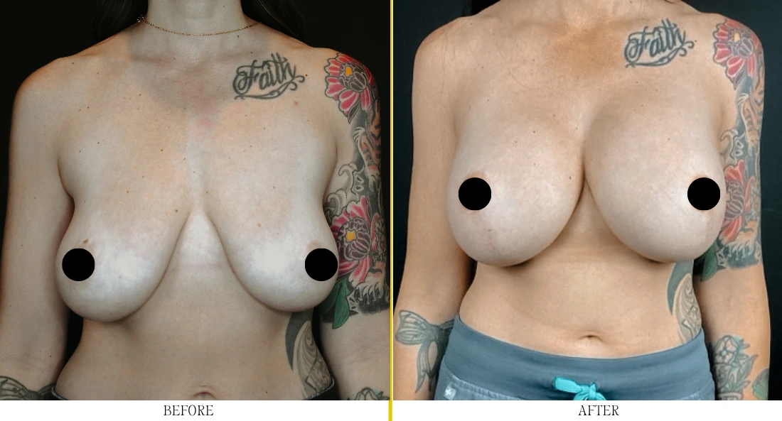 Before and after breast augmentation: front view showing increased breast volume and improved shape