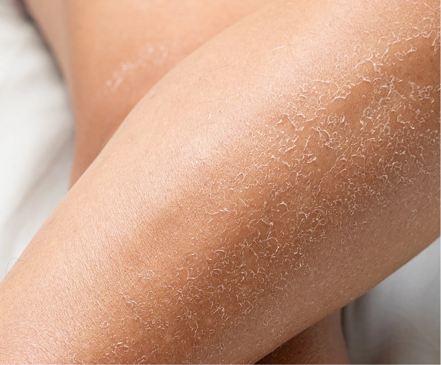Eczema Specialist Phoenix, AZ Banner