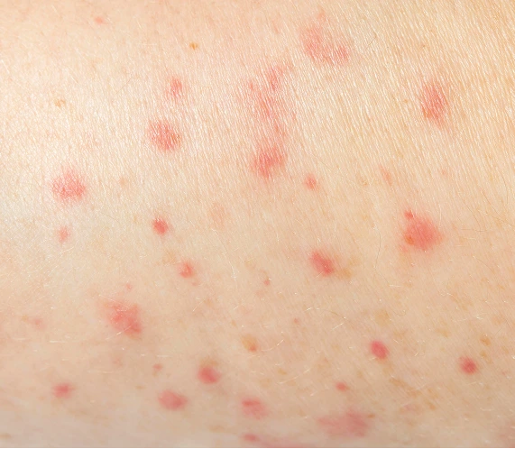 Folliculitis Treatment in Phoenix, AZ Banner