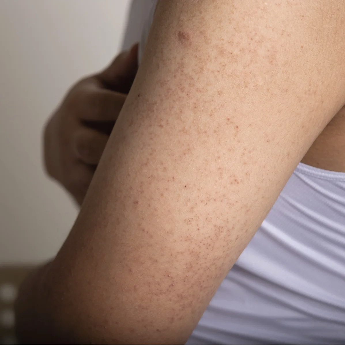 Person's arm showing scattered brown spots and age spots on skin