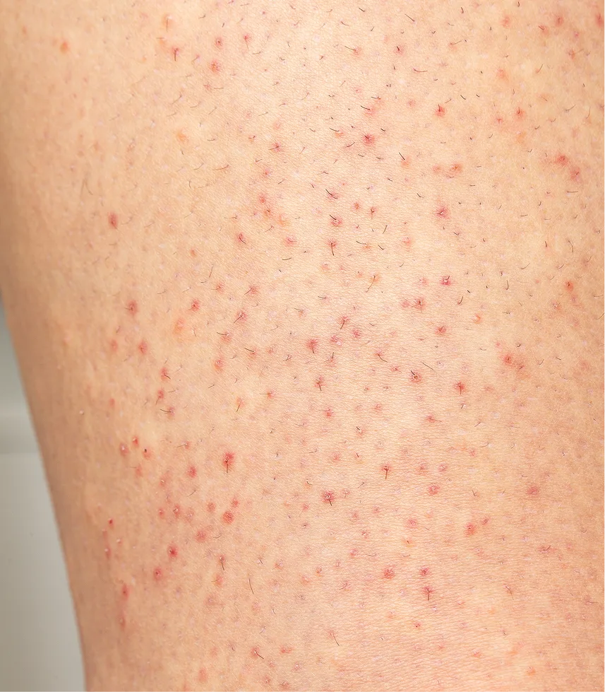 Close-up of skin with multiple small red keratosis lesions scattered across the surface