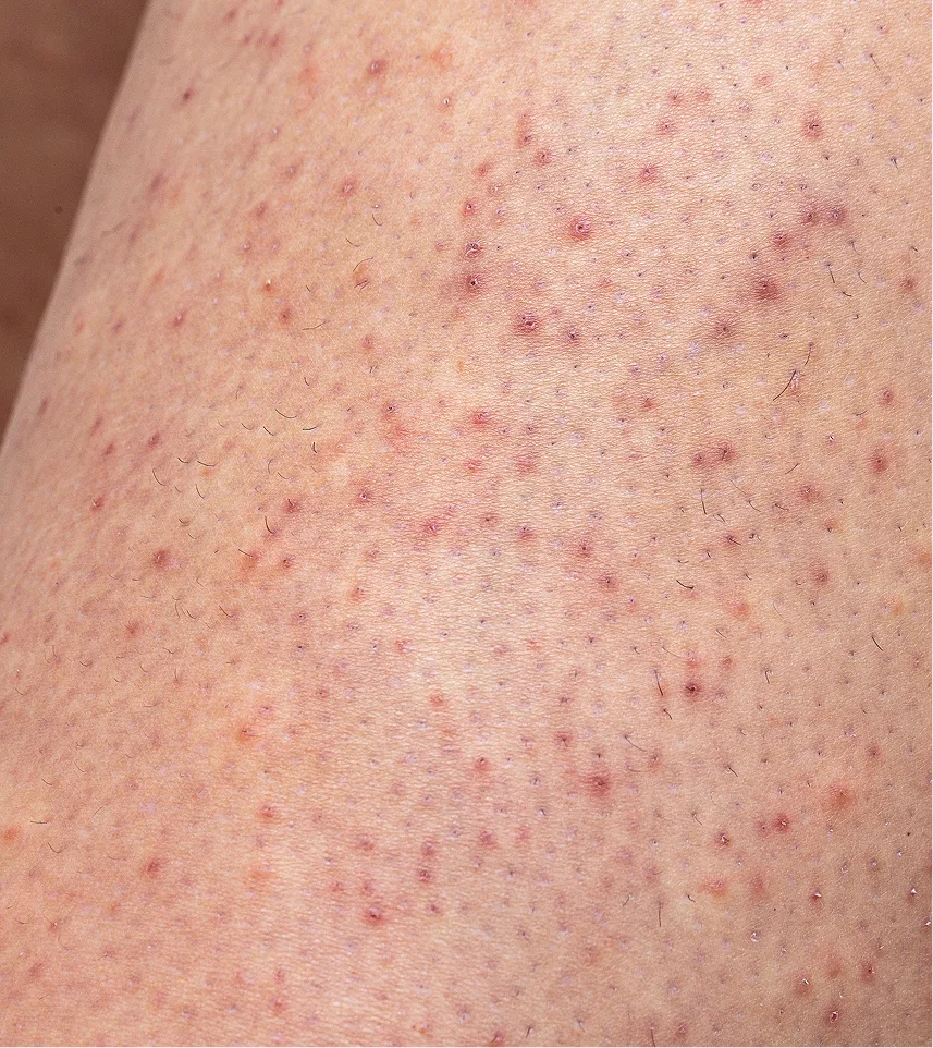 Close-up of skin showing red and purple keratosis growths distributed across the area