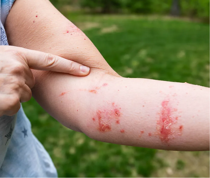Person's arm with red rash and inflamed patches, hand pointing to affected skin area