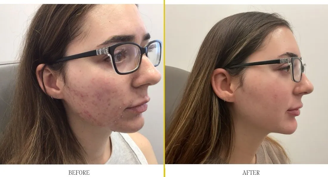 Before and after acne treatment showing profile view with improved skin clarity