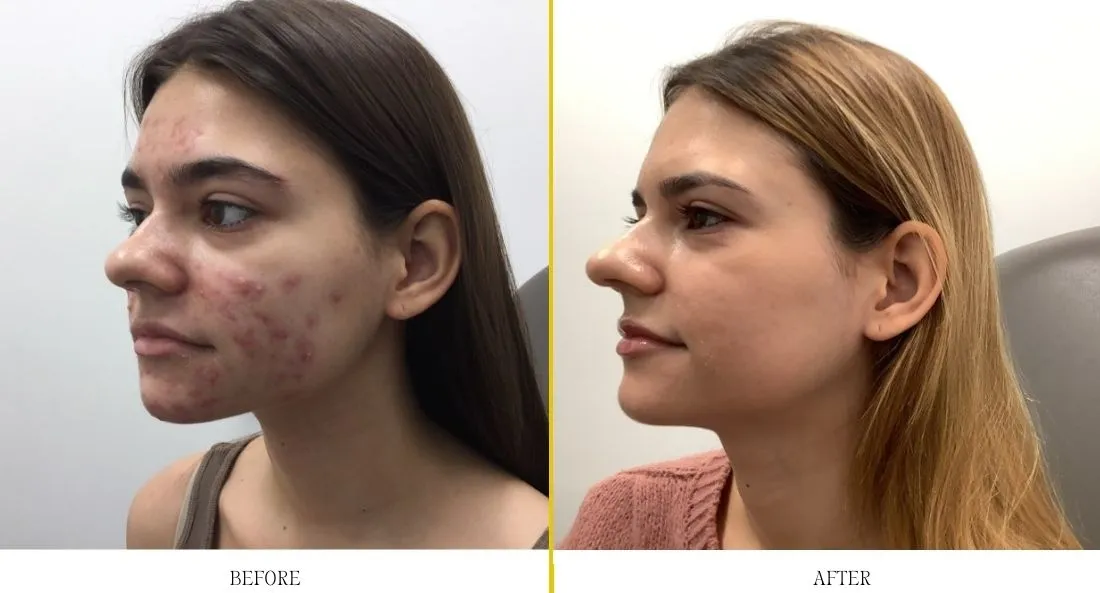 Before and after acne treatment showing profile view with reduced facial lesions