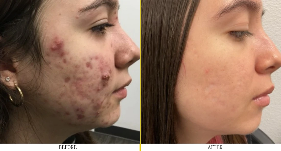 Woman's cheek in profile before and after acne treatment, showing significant reduction in breakouts and scarring