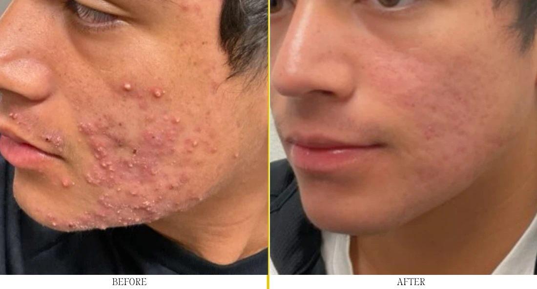 Man's cheek and jawline before and after acne treatment, showing cleared skin and reduced inflammation