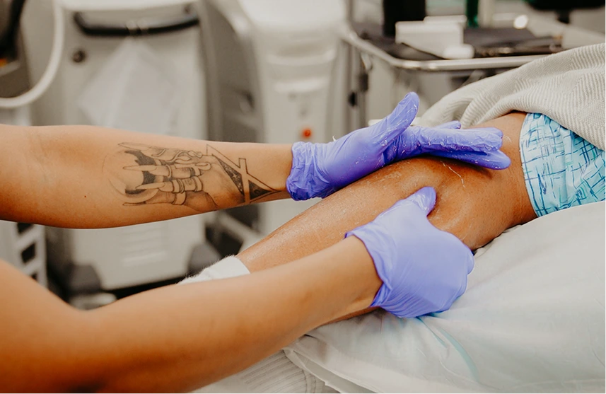 Gloved practitioner applying blue gel to patient's tattooed arm during laser procedure