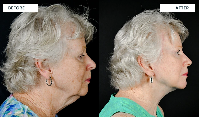 Before and after profile comparison: left shows loose skin and wrinkles, right shows tightened skin and defined jawline