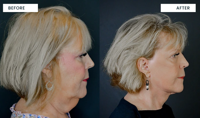 Before and after profile comparison: left shows aged skin texture, right shows refined skin and improved contours