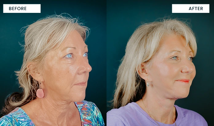 Before and after profile comparison: left shows sagging jawline, right shows lifted and contoured jawline