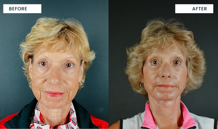 Before and after facial comparison: left shows wrinkled skin, right shows smoother, more refined appearance