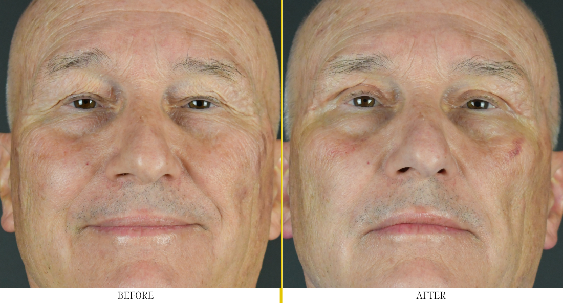 Blepharoplasty - Case 11