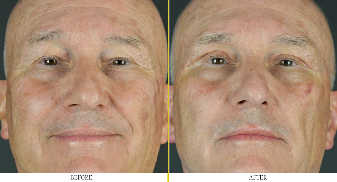 Before and after blepharoplasty showing reduced upper eyelid fullness and improved eye opening