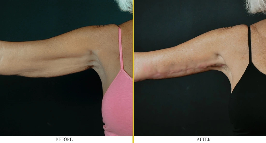 Before and after brachioplasty showing reduced inner arm sagging and improved skin tightness